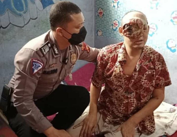 Warga Inhu Idap Tumor Ganas di Mata, Polisi Bantu Carikan Donasi